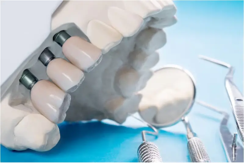 All-on-x dental implants pembroke pines