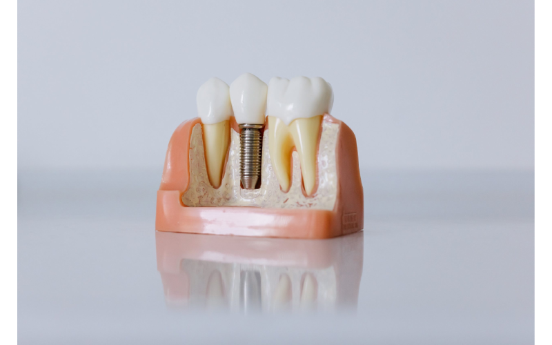 Dental Fillings in Houston