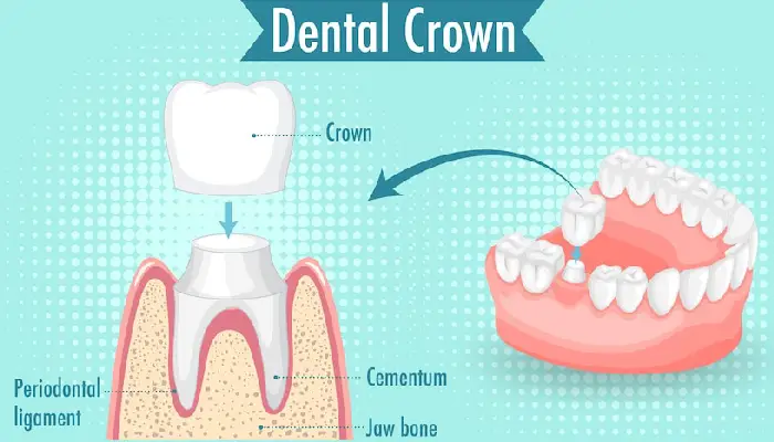 all on 4 dental implants pembroke pines