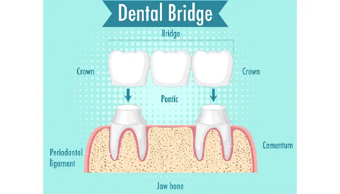 all on 4 dental implants pembroke pines